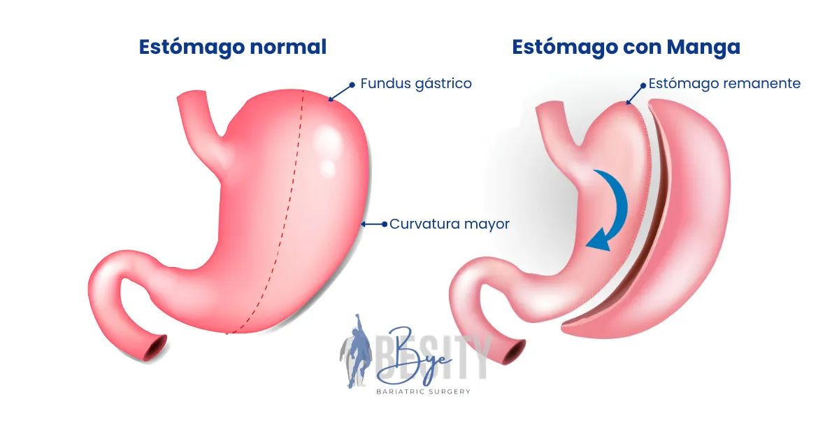 Manga Gastrico o Sleeve Gastrico que es