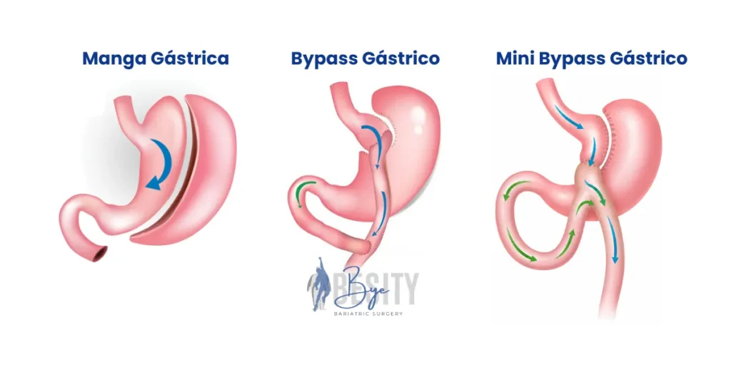 Tipos de Cirugia bariatrica, manga gastrica o sleeve gastrico, bypass gastrico y minibypass gastrico