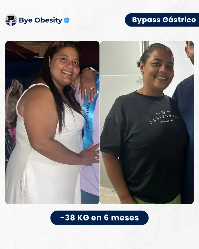 Resultados de Cirugia bariatrica, paciente que logró remision de diabetes tipo 2 y bajar más de 38 kilogramos de sobrepeso en 6 meses.